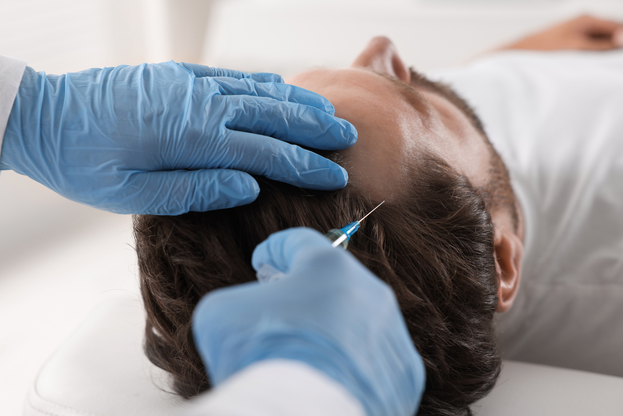 Man getting PRP hair restoration treatment